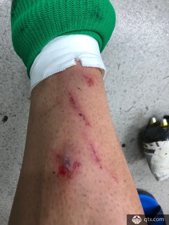 韋世豪微博曬傷口寫道 聯賽還沒結束 我們還有機會 韋世豪微博曬傷口寫道 聯賽還沒結束 我們還有機會