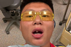 方昊傷情最新情況 撞擊斷裂4顆牙如今門牙隻剩1顆